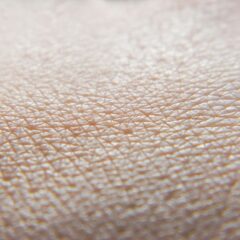 Enfermedades raras de la piel y su relación con la genética