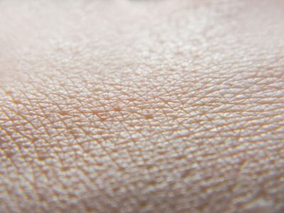 enfermedades raras de la piel