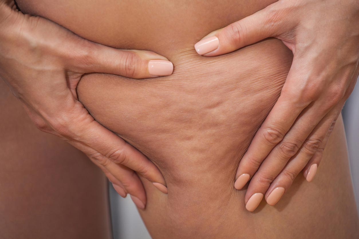 ¿Qué causa la celulitis?